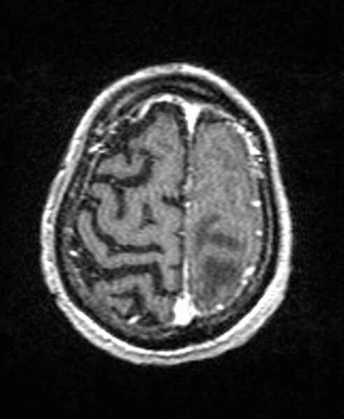 File:Brain abscess with dual rim sign (Radiopaedia 87566-103938 Axial T1 C+ 137).jpg