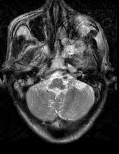 File:Brain abscess with dual rim sign (Radiopaedia 87566-103938 Axial T2 3).jpg