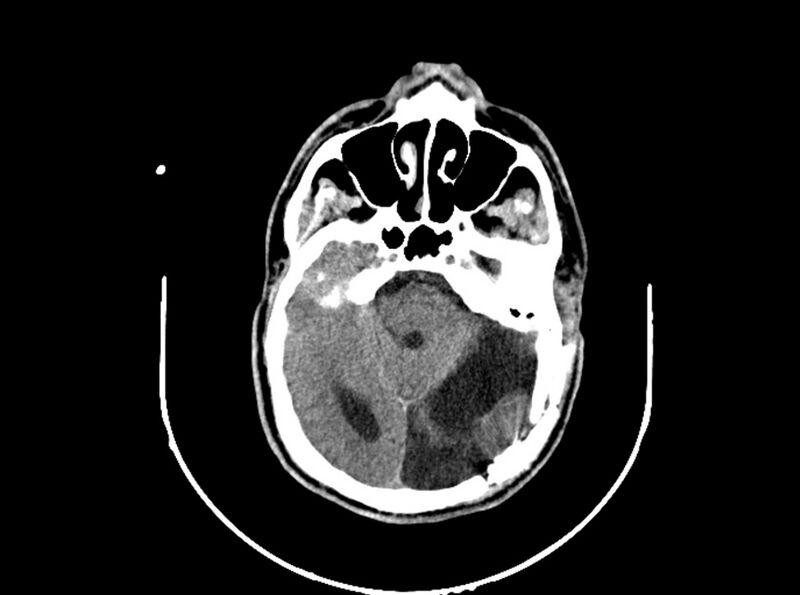 File:Brain injury by firearm projectile (Radiopaedia 82068-96088 A 98).jpg
