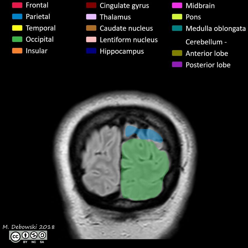 Brain lobes - annotated MRI (Radiopaedia 61691-69700 Coronal 70).JPG