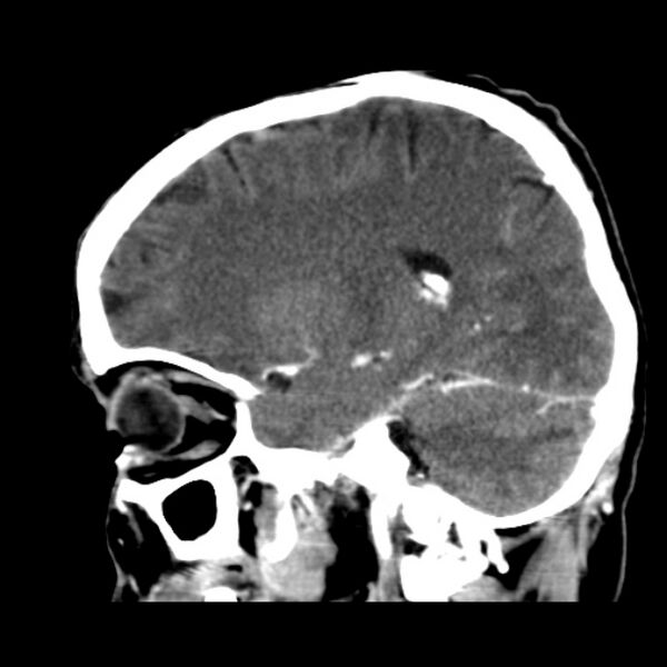 File:Brain metastases from lung cancer (Radiopaedia 24480-24781 C+ delayed 21).jpg