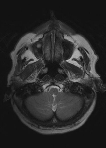File:Brain metastases from squamocellular lung cancer (Radiopaedia 56515-63222 Axial T2 4).jpg