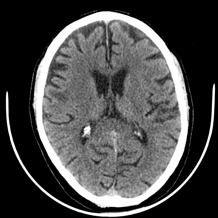 Brain metastasis (Radiopaedia 42617-45760 Axial non-contrast 26).jpg