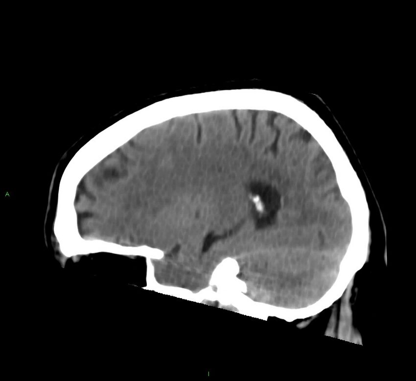 Brainstem hemorrhage (Radiopaedia 58794-66028 C 17).jpg
