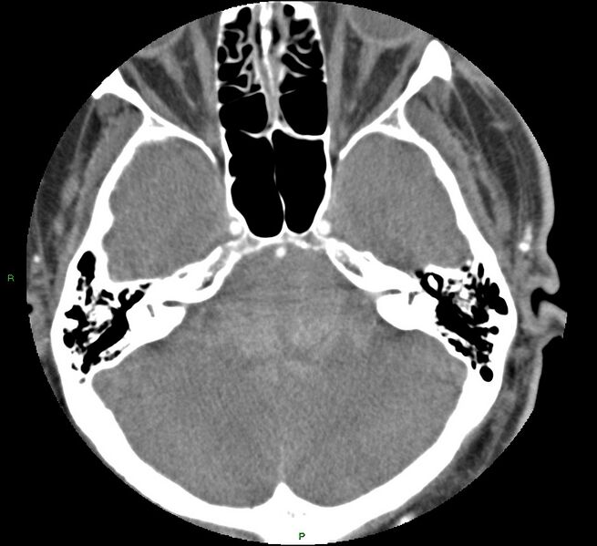 File:Brainstem hemorrhage (Radiopaedia 58794-66028 D 52).jpg