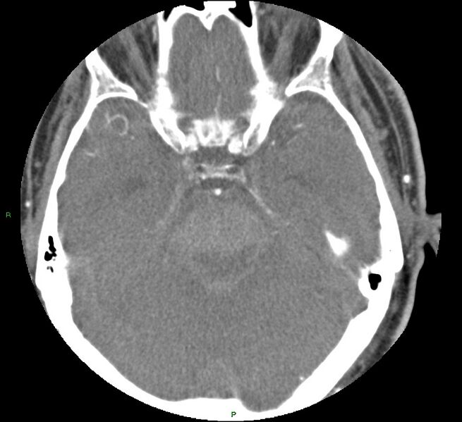 File:Brainstem hemorrhage (Radiopaedia 58794-66028 D 67).jpg