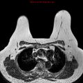 Breast carcinoma (multicentric multifocal in mammary Paget disease) (Radiopaedia 50966-56512 Axial T1 13).jpg