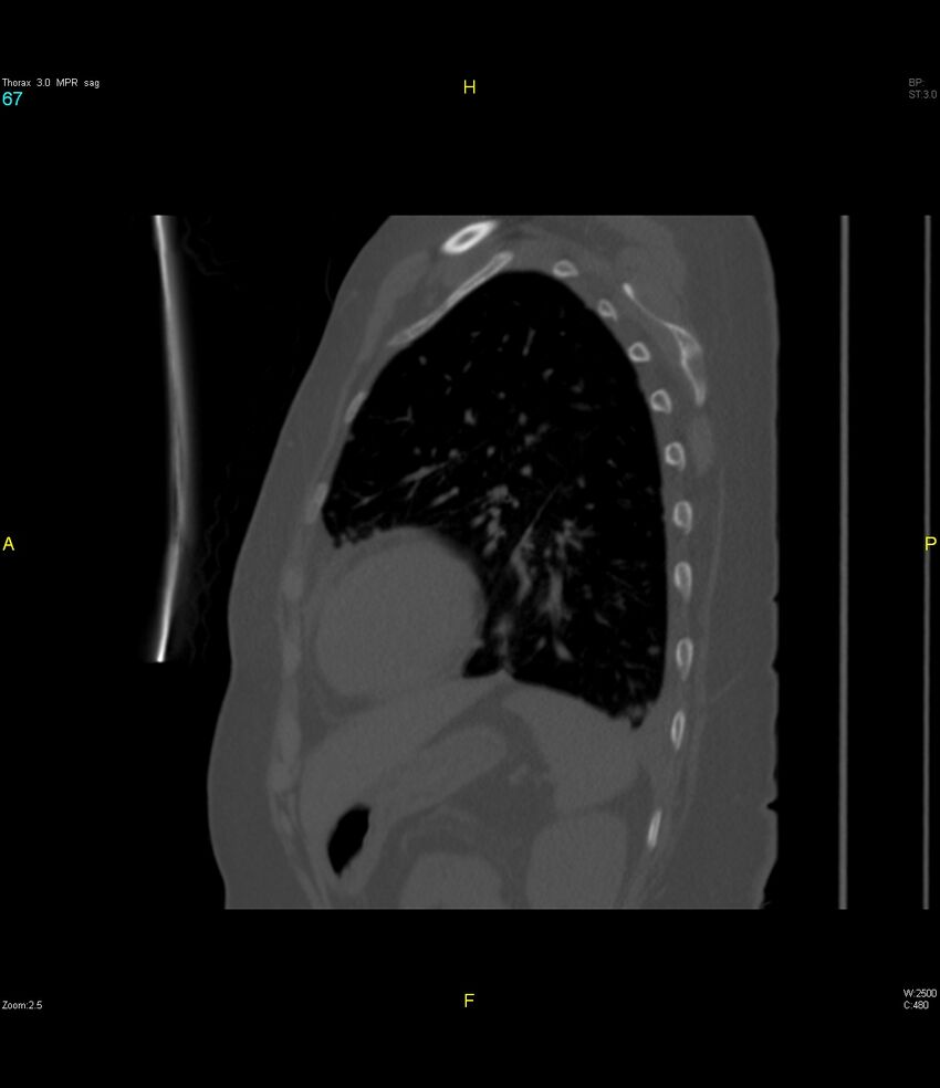 Breast primary with lung and bone metastases (Radiopaedia 40620-43228 Sagittal bone window 67).jpg