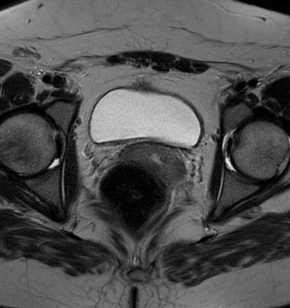 File:Broad ligament leiomyoma (Radiopaedia 81634-95516 Axial T2 19).jpg