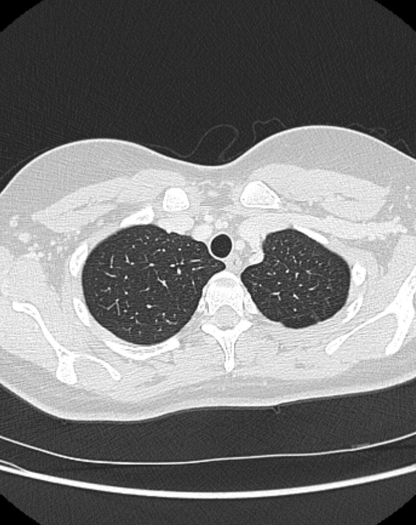 Bronchial atresia (Radiopaedia 50007-55297 Axial lung window 13).jpg