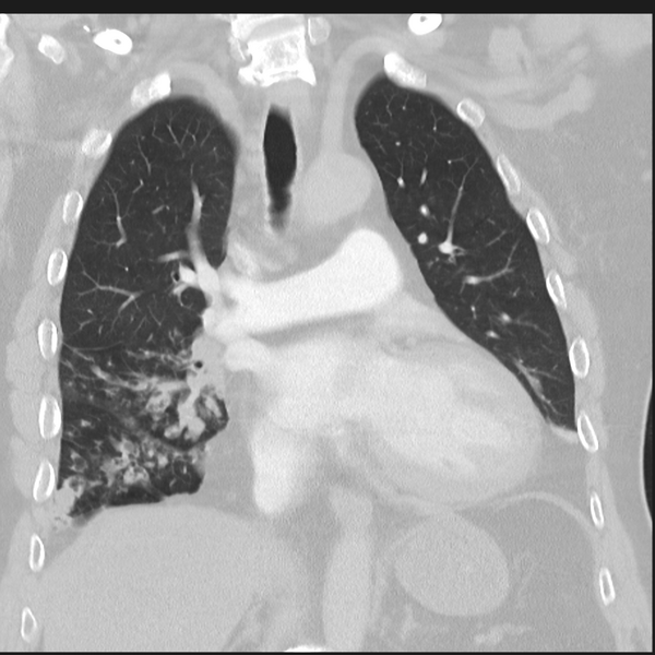 File:Bronchiectasis (Radiopaedia 39385-41666 Coronal lung window 14).png