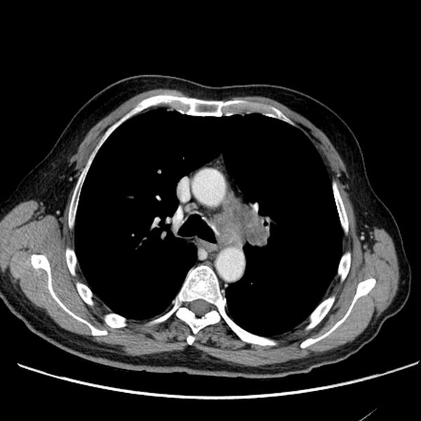 File:Bronchogenic carcinoma with L1 vertebra metastasis (Radiopaedia 9096-9805 Axial C+ delayed 11).jpg