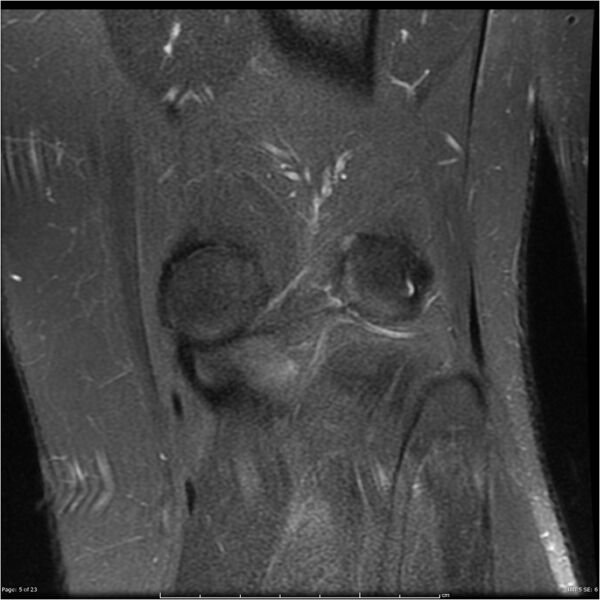 File:Bucket handle tear - lateral meniscus (Radiopaedia 7246-8187 Coronal T2 fat sat 5).jpg