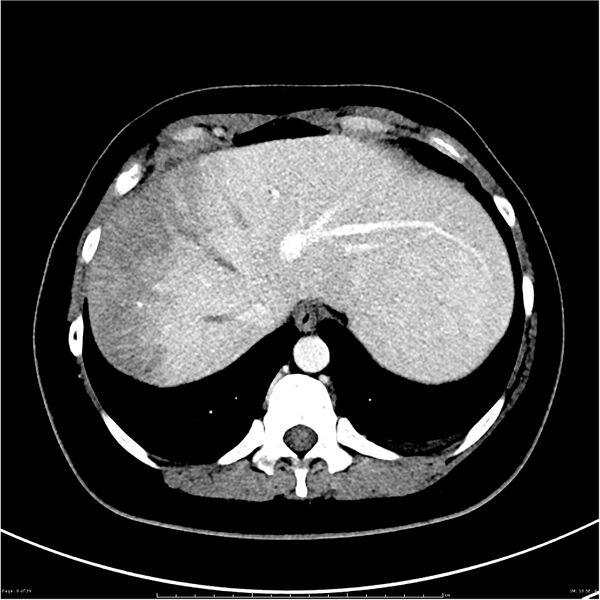 File:Budd-Chiari syndrome (Radiopaedia 27929-28177 Axial liver window 9).JPG