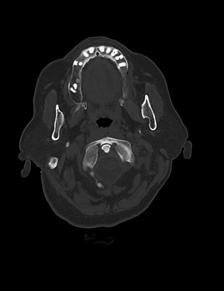 File:Burnt-out meningioma (Radiopaedia 51557-57337 Axial bone window 1).jpg