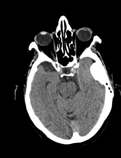 File:Burnt-out meningioma (Radiopaedia 51557-57337 Axial non-contrast 14).jpg