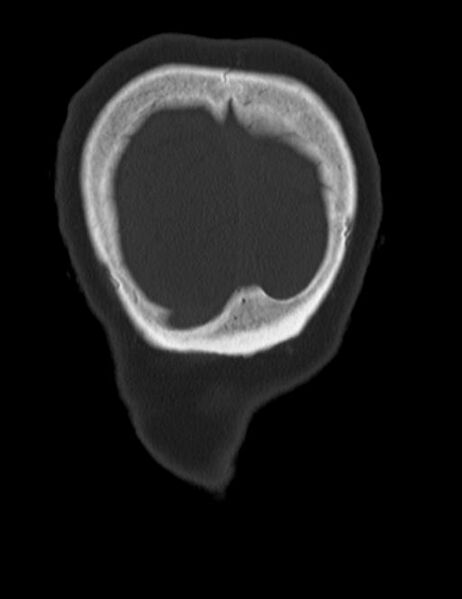 File:Burnt-out meningioma (Radiopaedia 51557-57337 Coronal bone window 52).jpg
