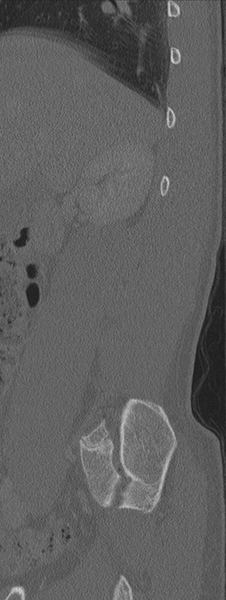 File:Burst fracture - T12 with conus compression (Radiopaedia 56825-63647 Sagittal bone window 75).png