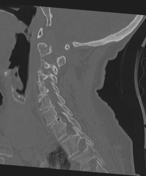 File:C2 fracture with vertebral artery dissection (Radiopaedia 37378-39199 Sagittal bone window 47).png