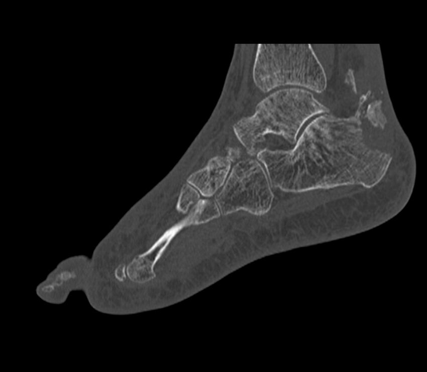 Calcaneal tuberosity avulsion fracture (Radiopaedia 22649-22668 Sagittal bone window 19).jpg
