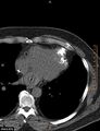 Calcified cardiac fibroma (Radiopaedia 39267-41519 Axial non-contrast 8).jpg