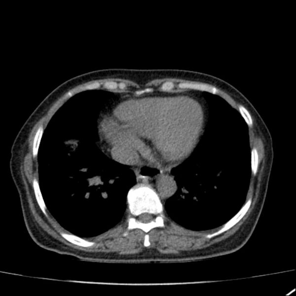 File:Calcified hepatic hydatid cyst (Radiopaedia 26872-27046 Axial non-contrast 9).jpg