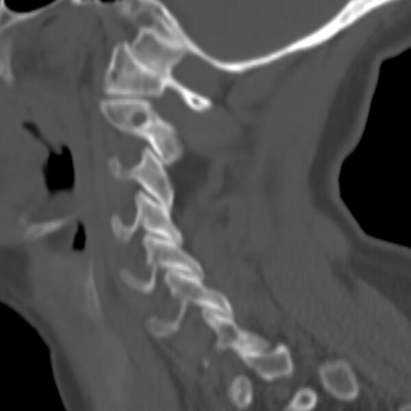 File:Calcified meningioma - cervical canal (Radiopaedia 70136-80171 Sagittal bone window 30).jpg