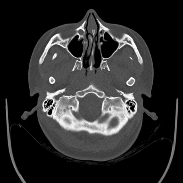 File:Calvarial osteoma (Radiopaedia 36520-38079 Axial bone window 15).jpg