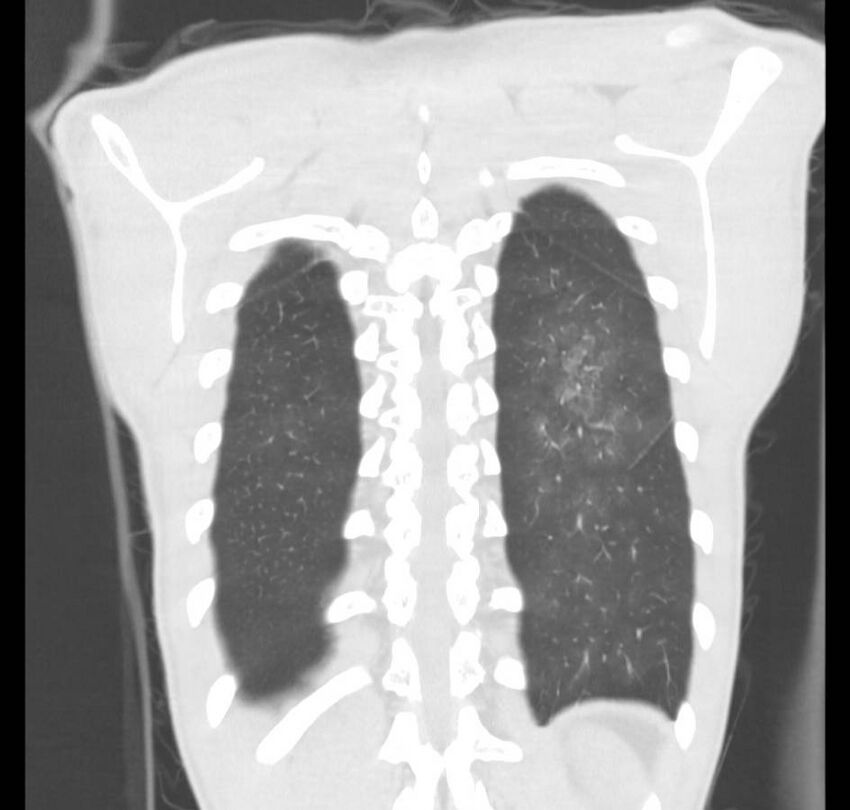 Cannabis-induced diffuse alveolar hemorrhage (Radiopaedia 89834-106946 Coronal lung window 12).jpg