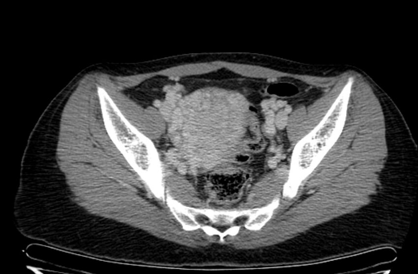 Cannonball metastases - uterine choriocarcinoma (Radiopaedia 70137-80174 A 19).jpg