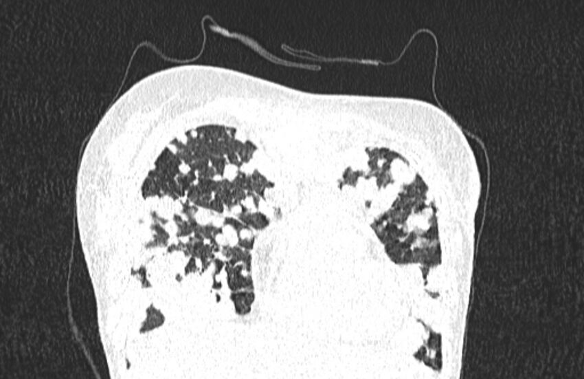 Cannonball metastases from breast cancer (Radiopaedia 91024-108569 Coronal lung window 28).jpg