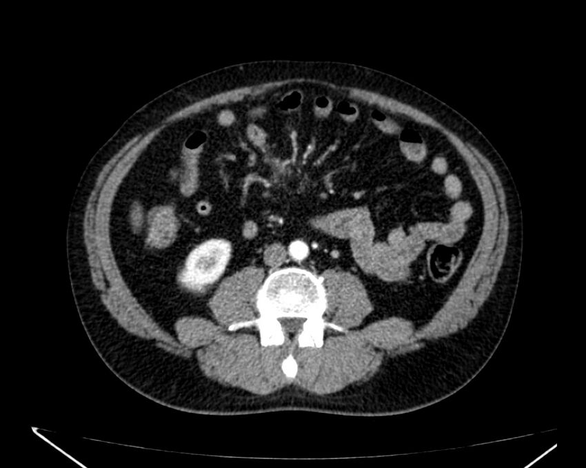 Carcinoid tumor with hepatic metastases (Radiopaedia 22651-22670 B 50).jpg