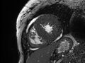 Cardiac amyloidosis (Radiopaedia 61600-69579 Short axis bSSFP 108).jpg