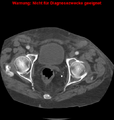 Cardiac perforation following transcatheter aortic valve implantation (Radiopaedia 23714-23863 B 6).png