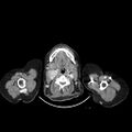 Carotid body tumor (Radiopaedia 21021-20948 A 18).jpg
