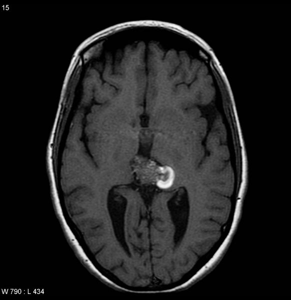 File:Cavernous malformation of the midbrain (Radiopaedia 7791-8615 Axial T1 4).jpg