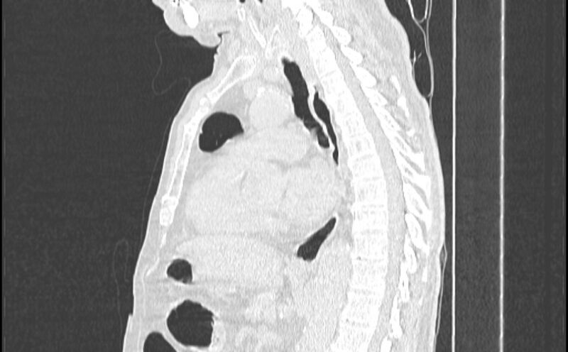 File:Cavitating bronchogenic carcinoma (Radiopaedia 44489-48162 Sagittal lung window 31).jpg