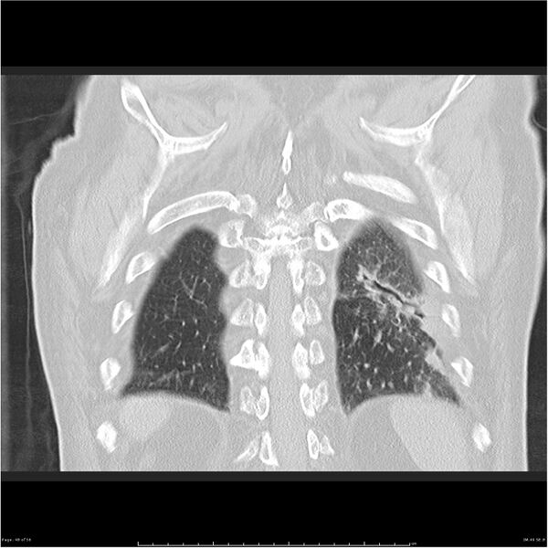 File:Cavitating left lower lobe lesion - squamous cell lung cancer (Radiopaedia 27749-28176 Coronal lung window 48).jpg