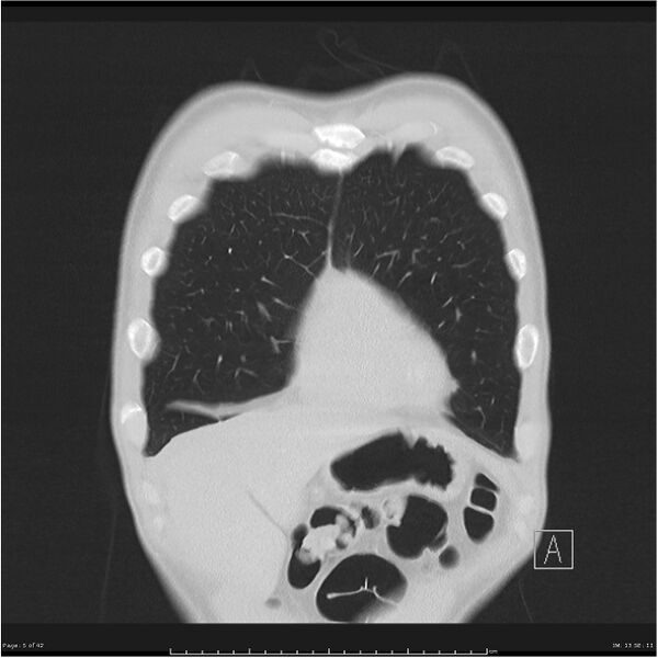 File:Cavitating lung cancer (Radiopaedia 25796-25945 lung window 5).jpg