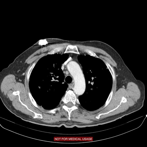 File:Cavitating pulmonary metastases (Radiopaedia 24920-25184 B 6).jpg