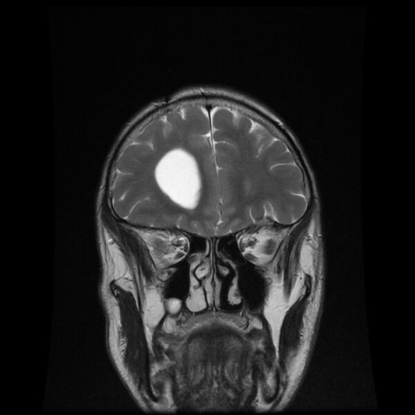 File:Central neurocytoma (Radiopaedia 67618-77021 Coronal T2 4).jpg