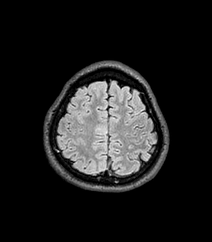 Central neurocytoma (Radiopaedia 79320-92380 Axial FLAIR 70).jpg