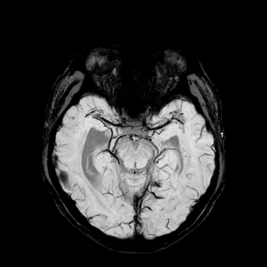 Central neurocytoma (Radiopaedia 79320-92380 Axial SWI 51).jpg