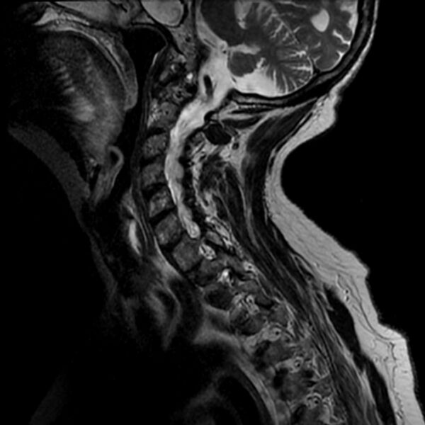 File:Cerebellar ataxia with neuropathy and vestibular areflexia syndrome (CANVAS) (Radiopaedia 74283-85159 Sagittal T2 8).jpg