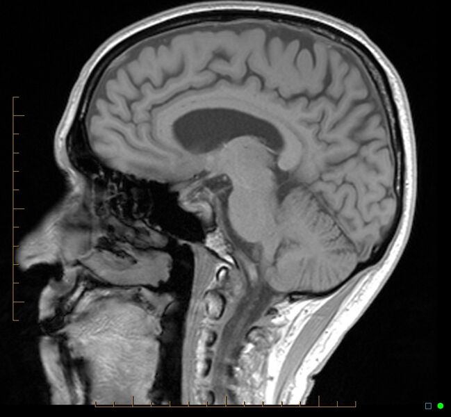 File:Cerebellar gangliocytoma (Radiopaedia 65377-74422 Sagittal T1 19).jpg