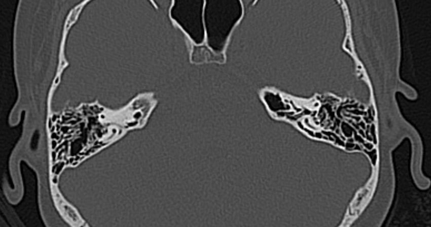 Cerebellopontine angle lipoma (Radiopaedia 57303-64242 Axial bone window 39).jpg