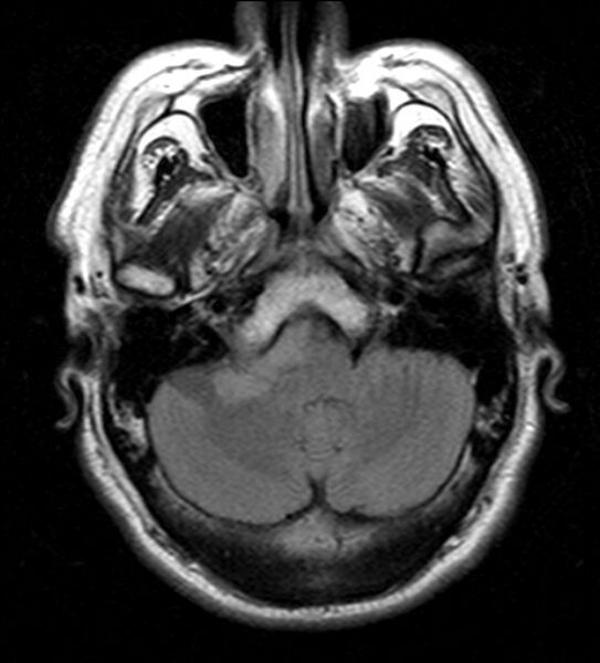 File:Cerebellopontine angle meningioma (Radiopaedia 24459-24764 Axial FLAIR 5).jpg