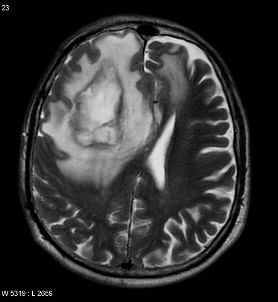 File:Cerebral abscesses secondary to contusions (Radiopaedia 5201-6968 Axial T2 4).jpg