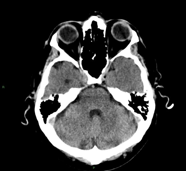 File:Cerebral amyloid angiopathy-associated lobar intracerebral hemorrhage (Radiopaedia 58376-65511 Axial non-contrast 41).jpg
