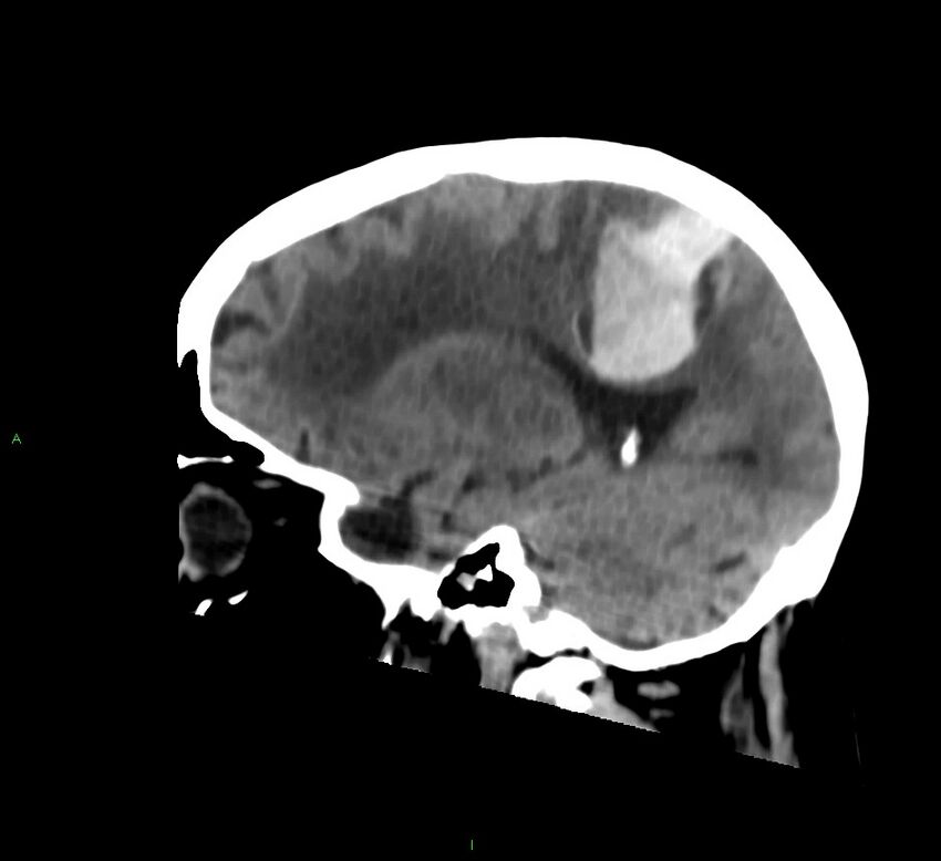Cerebral amyloid angiopathy-associated lobar intracerebral hemorrhage (Radiopaedia 58530-65688 C 36).jpg